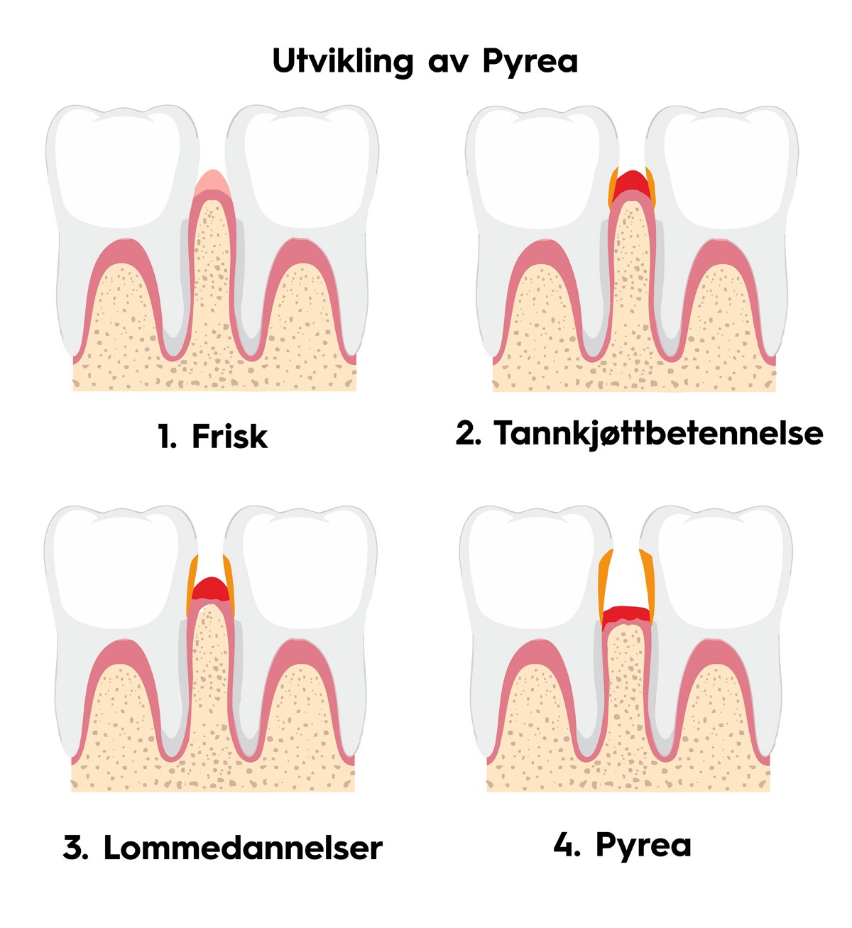 Utvikling av Pyrea Utvikling av Pyrea